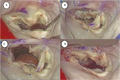 Thoracoscopic Trans-mitral Septal Myectomy for Hypertrophic Obstructive Cardiomyopathy in the Elderly